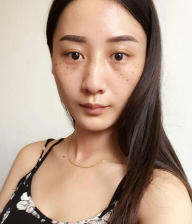 有誰(shuí)做過(guò)激光祛雀斑？個(gè)人激光祛雀斑后恢復(fù)日記分享