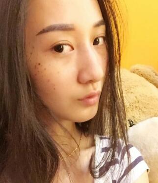 有誰(shuí)做過(guò)激光祛雀斑？個(gè)人激光祛雀斑后恢復(fù)日記分享