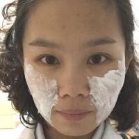 玻尿酸去法令紋后人變年輕了好幾歲