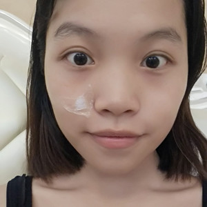 海口紅妝李杰醫(yī)生給我做的激光點(diǎn)痣，分享一下前后對比圖片