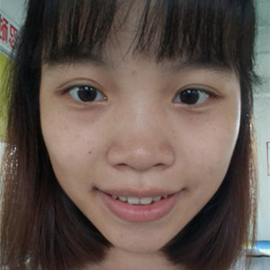 海口紅妝李杰醫(yī)生給我做的激光點(diǎn)痣，分享一下前后對比圖片