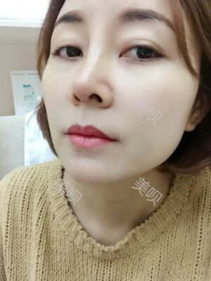 成都隆鼻整形整真實(shí)恢復(fù)圖片，終于有了韓式小翹鼻