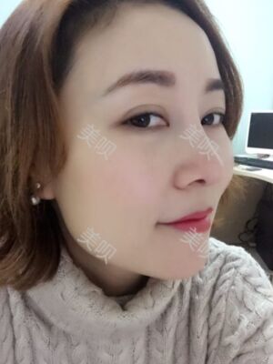 成都隆鼻整形整真實(shí)恢復(fù)圖片，終于有了韓式小翹鼻