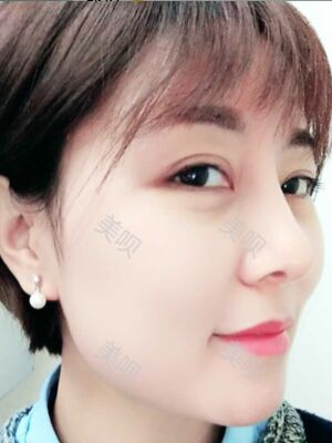 成都隆鼻整形整真實(shí)恢復(fù)圖片，終于有了韓式小翹鼻