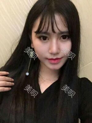 線D隆鼻恢復(fù)過程圖片，真實(shí)案例照片