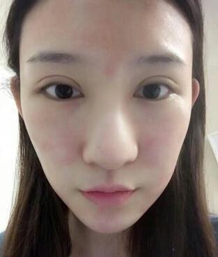 隆鼻失敗修復(fù)后恢復(fù)圖分享，鼻子修復(fù)價(jià)格9800元