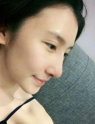 隆鼻失敗修復(fù)后恢復(fù)圖分享，鼻子修復(fù)價(jià)格9800元