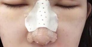 隆鼻失敗修復(fù)后恢復(fù)圖分享，鼻子修復(fù)價(jià)格9800元