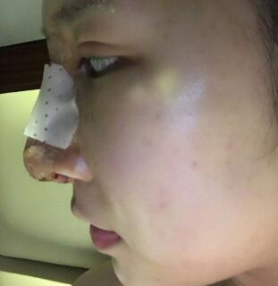 隆鼻失敗修復(fù)后恢復(fù)圖分享，鼻子修復(fù)價(jià)格9800元