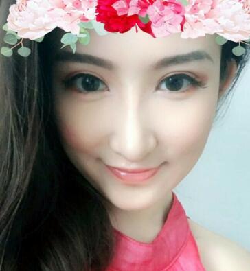 隆鼻失敗修復(fù)后恢復(fù)圖分享，鼻子修復(fù)價(jià)格9800元