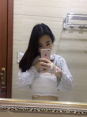 自體脂肪隆胸手術(shù)真實案例——邯鄲雅乾侯德勝醫(yī)生做的