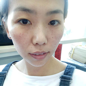 激光祛曬斑真實案例分享，并附上前后對比圖片