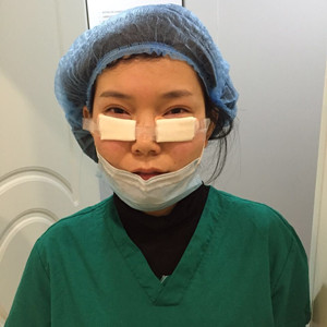 激光祛眼袋手術真實案例——邯鄲雅乾劉紅艷醫(yī)生做的