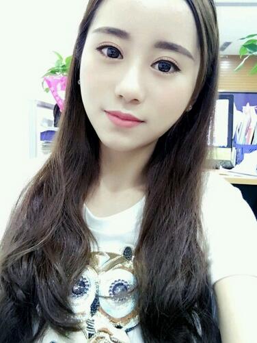 割雙眼皮案例圖片 雙眼皮手術(shù)20天