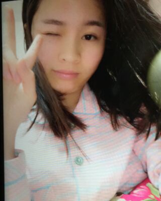 激光祛痘三次對(duì)比圖，痘痘全消除了