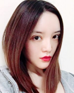 全切雙眼皮+硅膠墊下巴真實案例對比圖