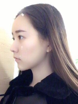 自體脂肪詳細部填充日記，恢復(fù)過程分享