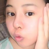 鼻部綜合整形恢復(fù)過程圖分享