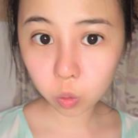 鼻部綜合整形恢復(fù)過程圖分享