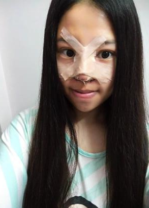 鼻部綜合整形恢復(fù)過程圖分享