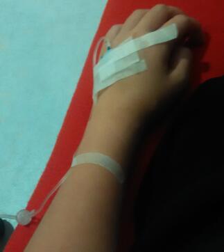 鼻部綜合整形恢復(fù)過程圖分享