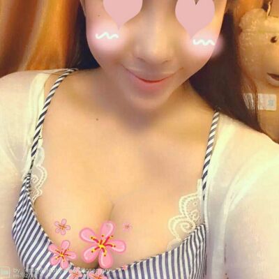 自體脂肪豐胸對(duì)比照片，福州愛美爾張勝利做的