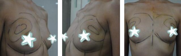 自體脂肪移植隆胸果圖分享，吸脂隆胸價(jià)格18800元