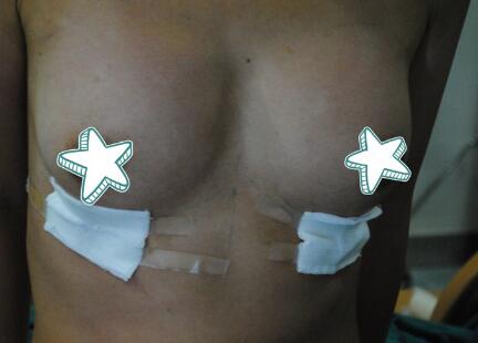 自體脂肪移植隆胸果圖分享，吸脂隆胸價(jià)格18800元