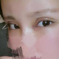 開內(nèi)眼角割雙眼皮恢復(fù)全過程和圖片分享