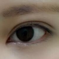開內(nèi)眼角割雙眼皮恢復(fù)全過程和圖片分享
