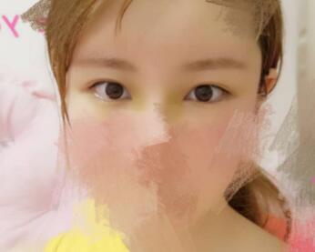 開內眼角割雙眼皮恢復全過程和圖片分享，雙眼皮多項整形整形