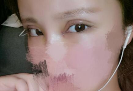 開內眼角割雙眼皮恢復全過程和圖片分享，雙眼皮多項整形整形