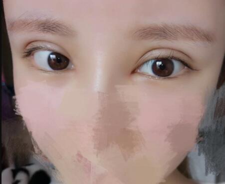 開內眼角割雙眼皮恢復全過程和圖片分享，雙眼皮多項整形整形