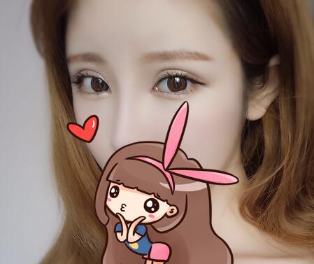 開內眼角割雙眼皮恢復全過程和圖片分享，雙眼皮多項整形整形