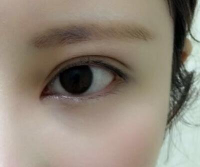 開內眼角割雙眼皮恢復全過程和圖片分享，雙眼皮多項整形整形