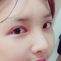 做了割雙眼皮和開內(nèi)眼角雙眼皮多項整形整形手術(shù)，恢復(fù)圖片日志分享