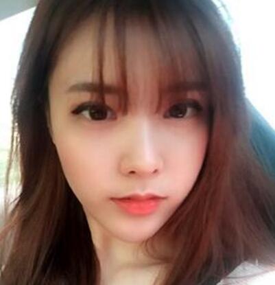 做了割雙眼皮和開內(nèi)眼角雙眼皮多項(xiàng)整形整形手術(shù)，恢復(fù)圖片日志分享