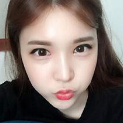 做了割雙眼皮和開內(nèi)眼角雙眼皮多項(xiàng)整形整形手術(shù)，恢復(fù)圖片日志分享