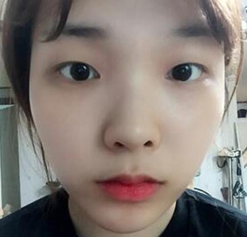 做了割雙眼皮和開內(nèi)眼角雙眼皮多項(xiàng)整形整形手術(shù)，恢復(fù)圖片日志分享