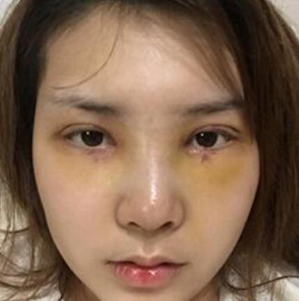 做了割雙眼皮和開內(nèi)眼角雙眼皮多項(xiàng)整形整形手術(shù)，恢復(fù)圖片日志分享