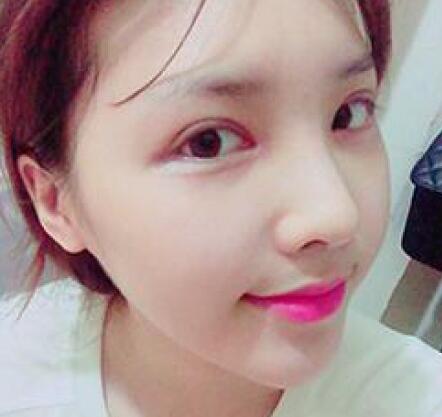 做了割雙眼皮和開內(nèi)眼角雙眼皮多項(xiàng)整形整形手術(shù)，恢復(fù)圖片日志分享