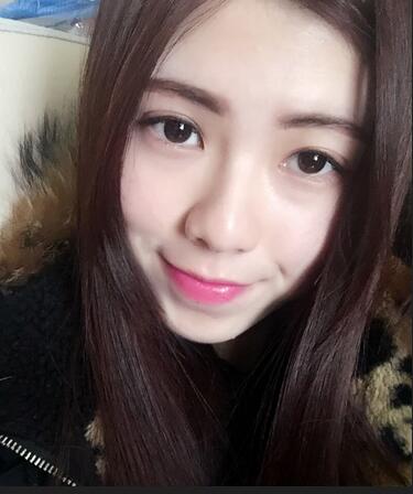 廣州凱美達(dá)微創(chuàng)雙眼皮手術(shù)恢復(fù)期紀(jì)實