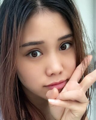 雙眼皮失敗修復(fù)果圖，福州愛美爾王召克做的