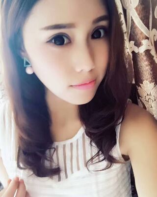 雙眼皮失敗修復(fù)果圖，福州愛美爾王召克做的