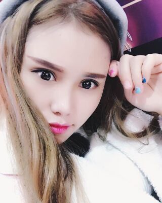 雙眼皮失敗修復(fù)果圖，福州愛美爾王召克做的