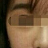 在濟南吉芙醫(yī)院做的玻尿酸填充淚溝，填充淚溝圖片分享