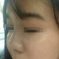 在濟南吉芙醫(yī)院做的玻尿酸填充淚溝，填充淚溝圖片分享