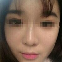 在濟南吉芙醫(yī)院做的玻尿酸填充淚溝，填充淚溝圖片分享