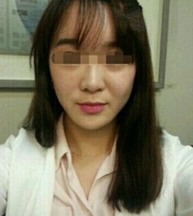 在濟(jì)南吉芙醫(yī)院做的玻尿酸填充淚溝，填充淚溝圖片分享