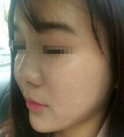 在濟(jì)南吉芙醫(yī)院做的玻尿酸填充淚溝，填充淚溝圖片分享
